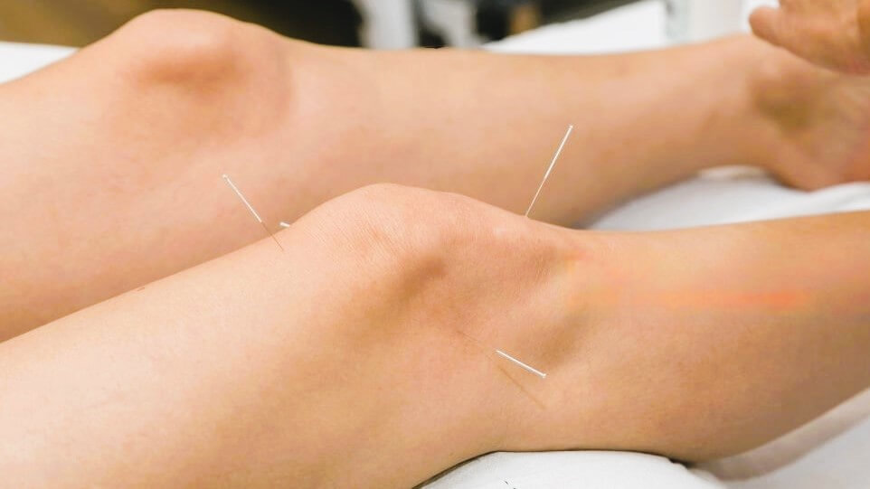 An image representing the practice of acupuncture, which involves the insertion of thin needles into specific points on the body.
