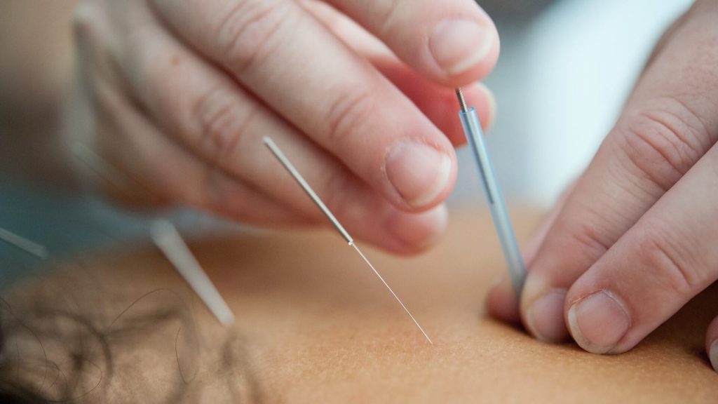 A professional acupuncturist, ready to provide acupuncture treatment.