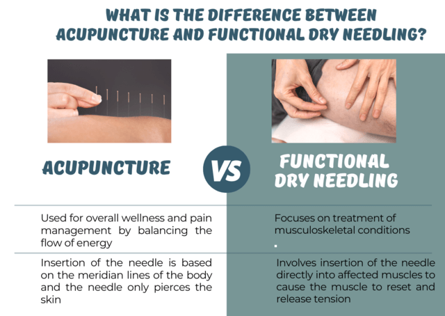 Main differences between dry needling and acupuncture