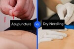 Acupuncture vs. Dry Needling - What is the difference between the two?